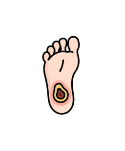 Diabetic Foot Ulcer
