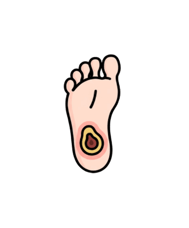 Diabetic Foot Ulcer