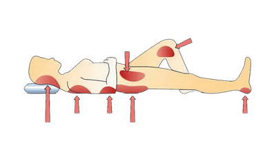 Pressure Ulcer