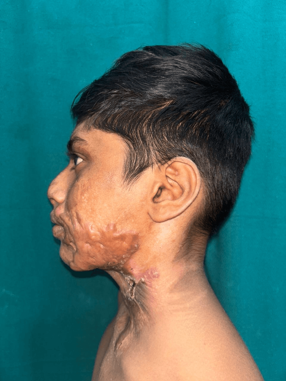 After Skin Grafting