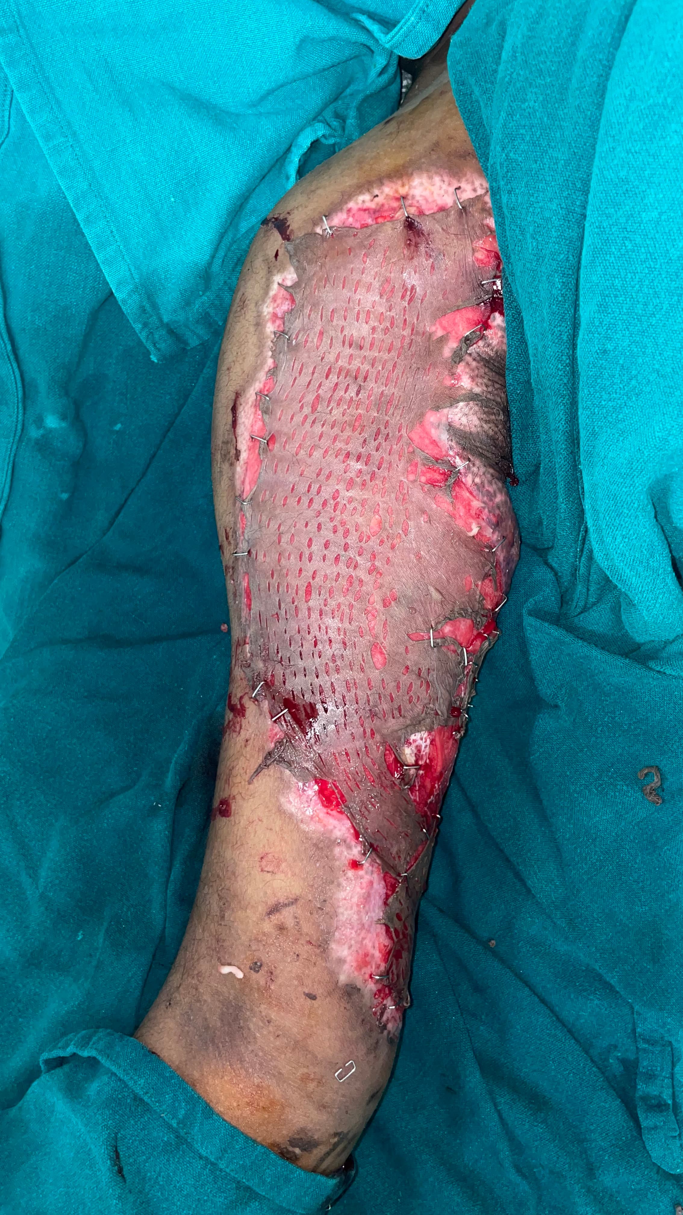 After Skin Grafting