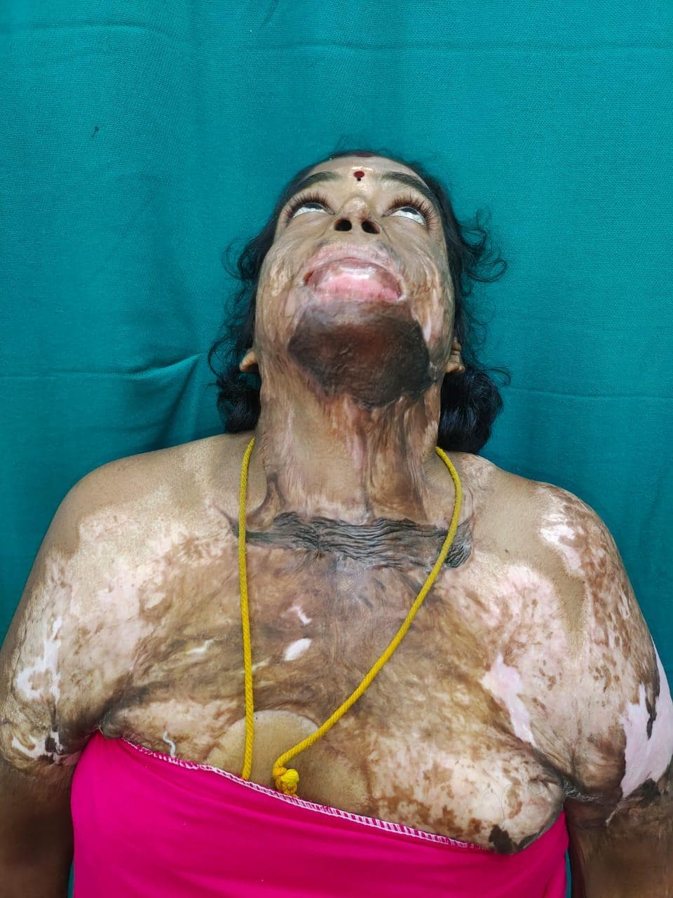 After Skin Grafting
