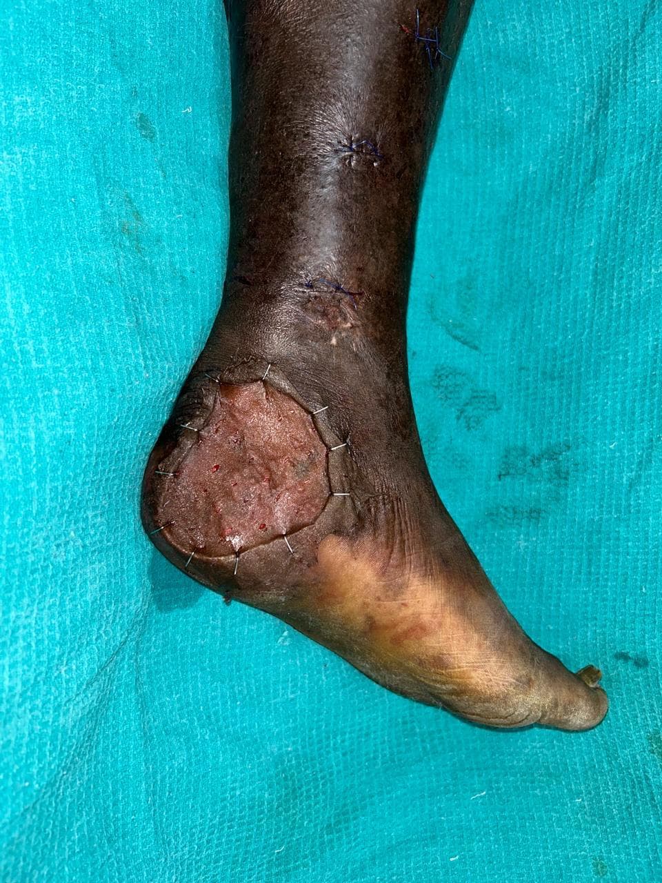 Post-Reconstruction