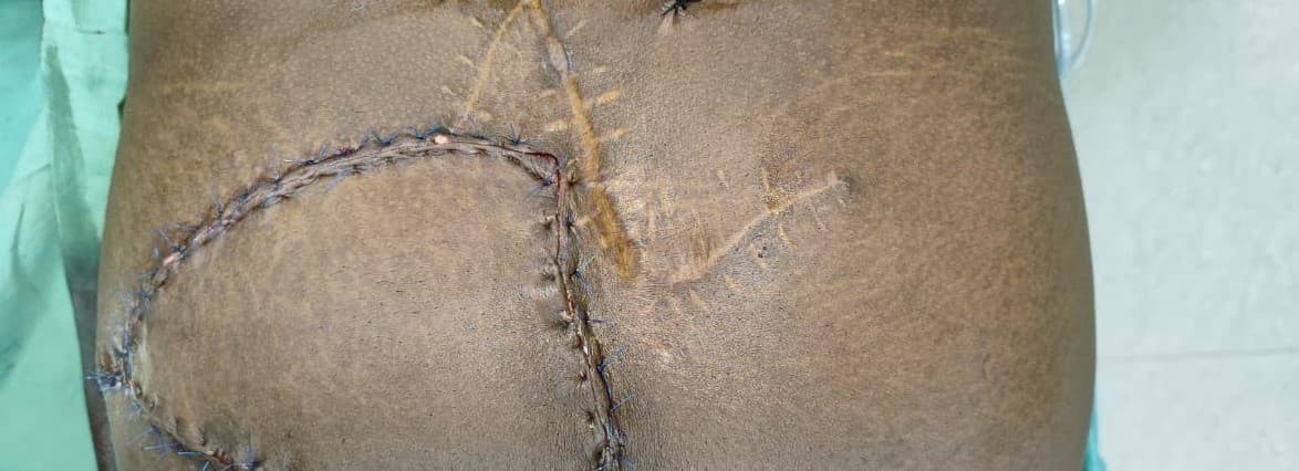 After Tissue Reconstruction