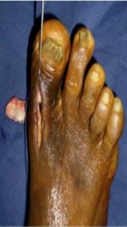 Before Treatment