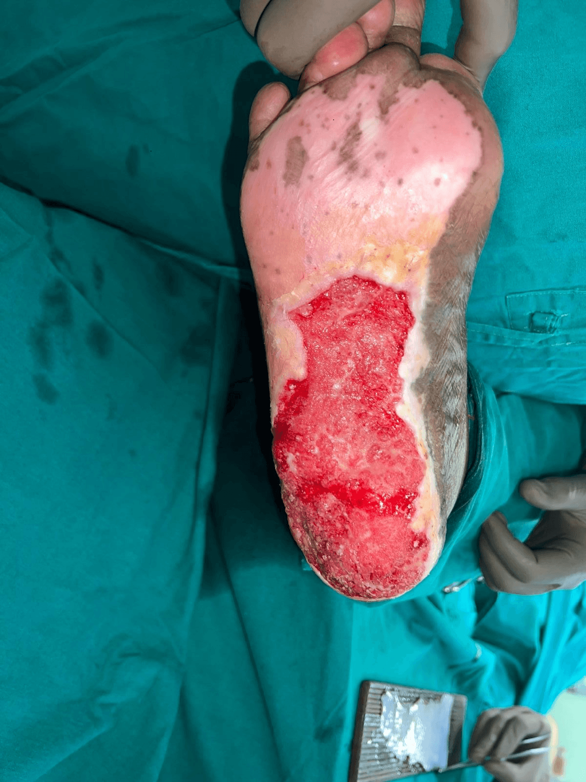 Before Treatment