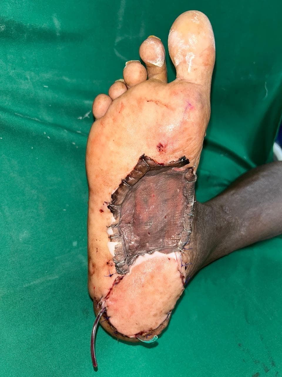After Healing