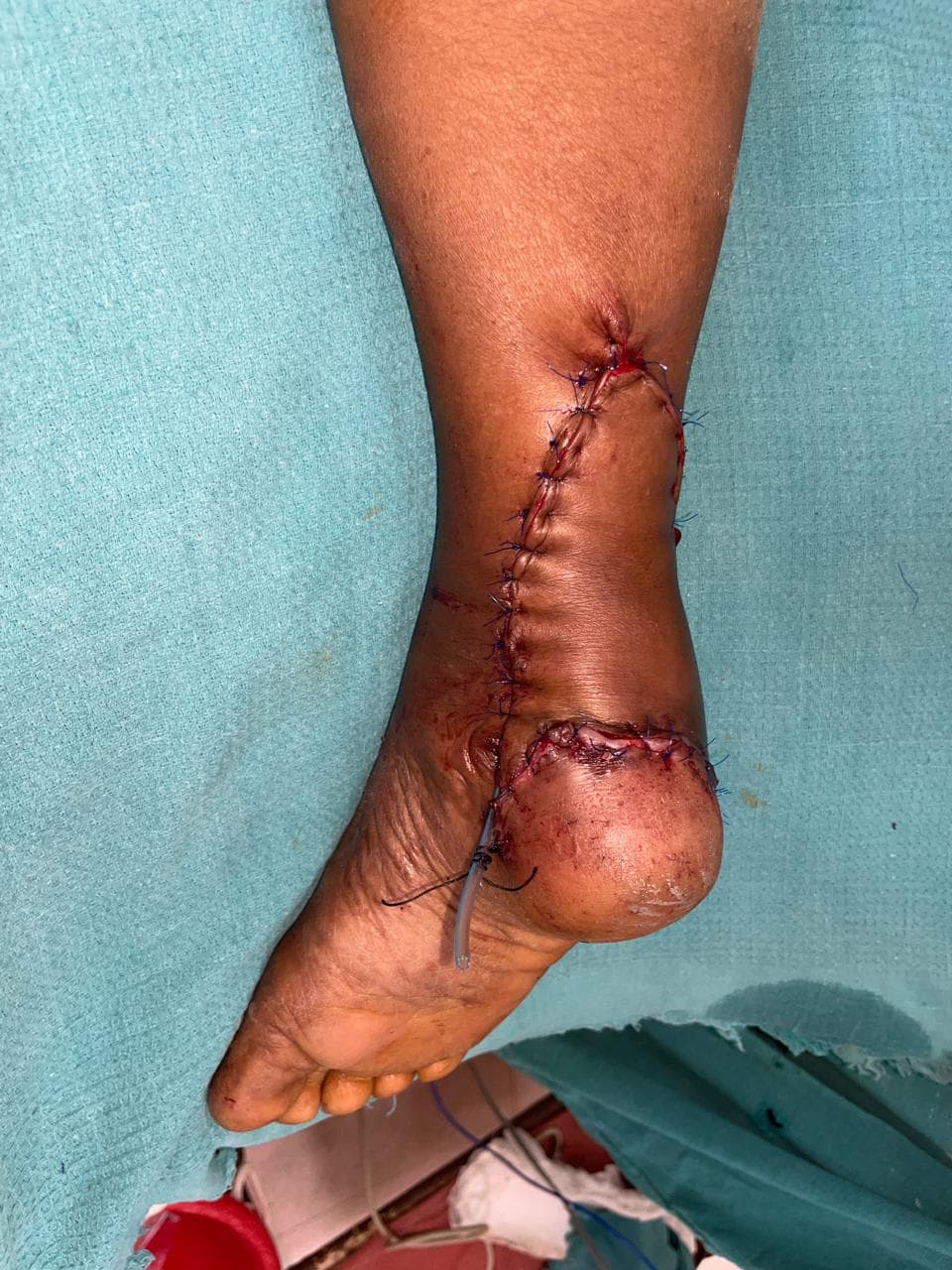 After Healing
