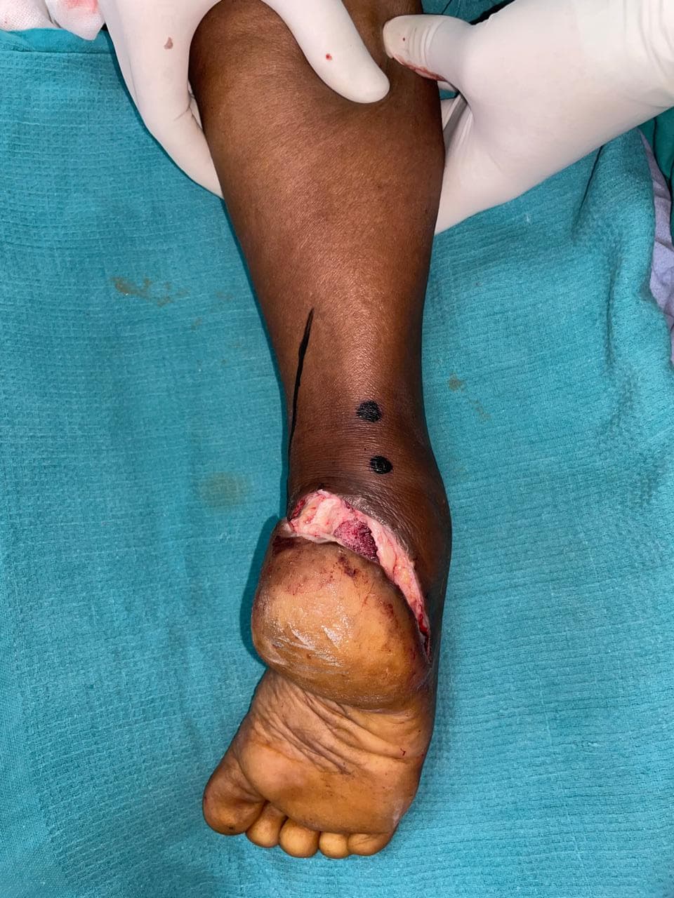Before Treatment