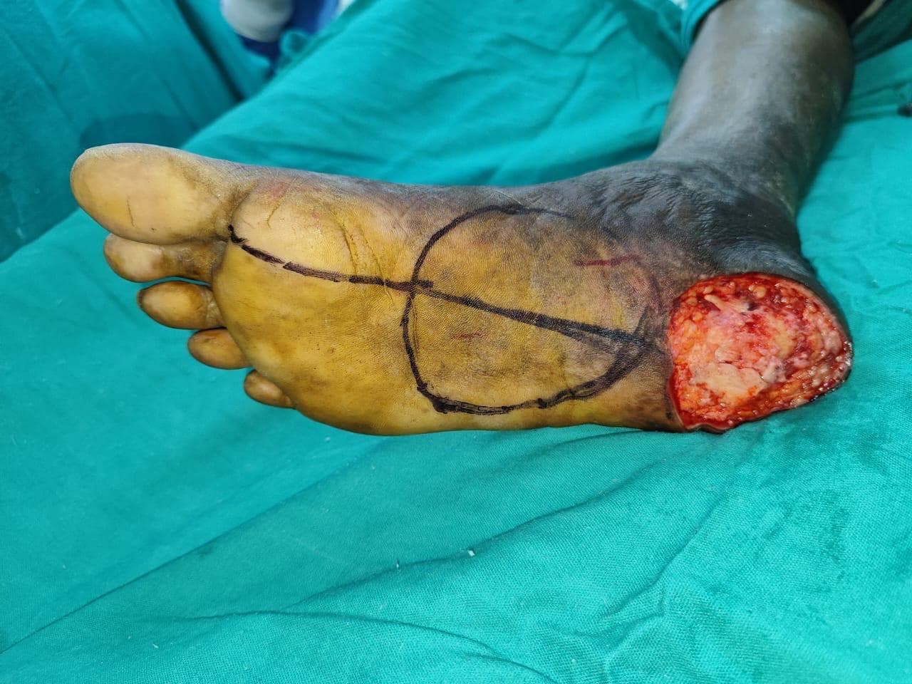 Before Treatment