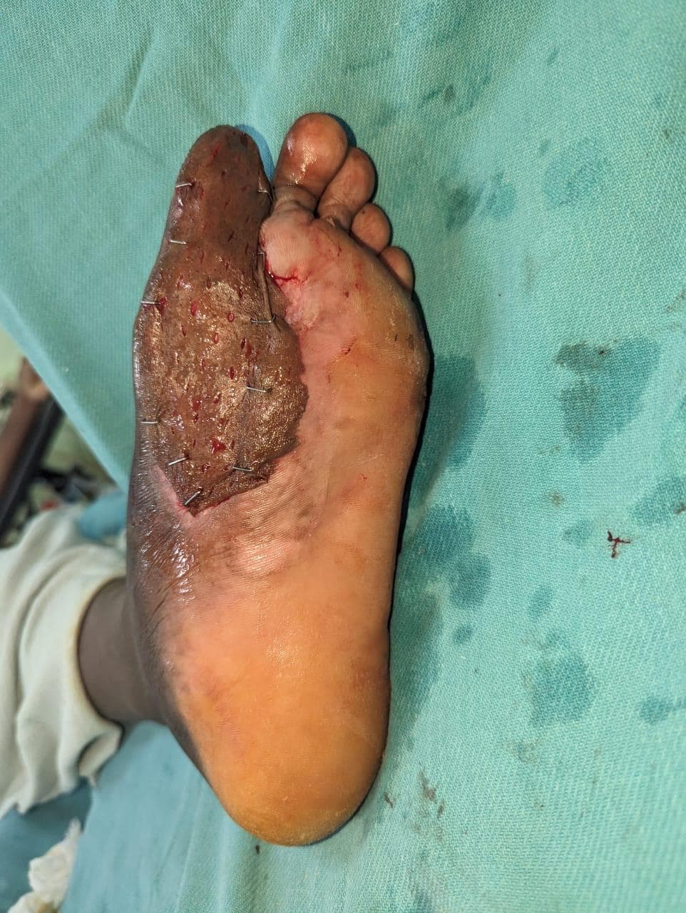 After Healing