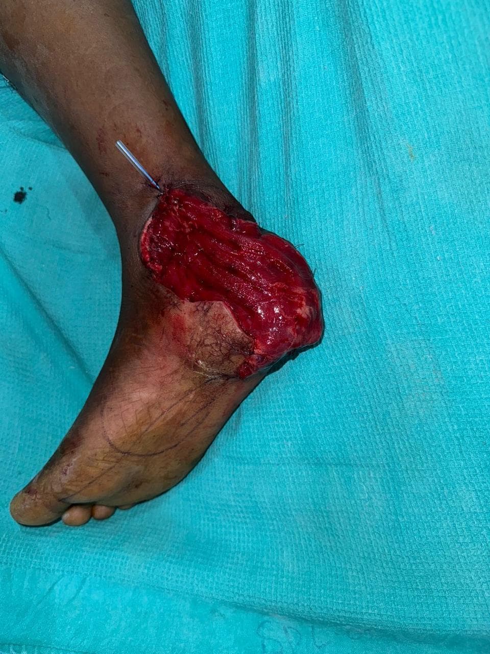 After Healing