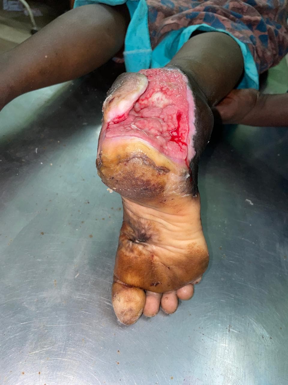 Before Treatment